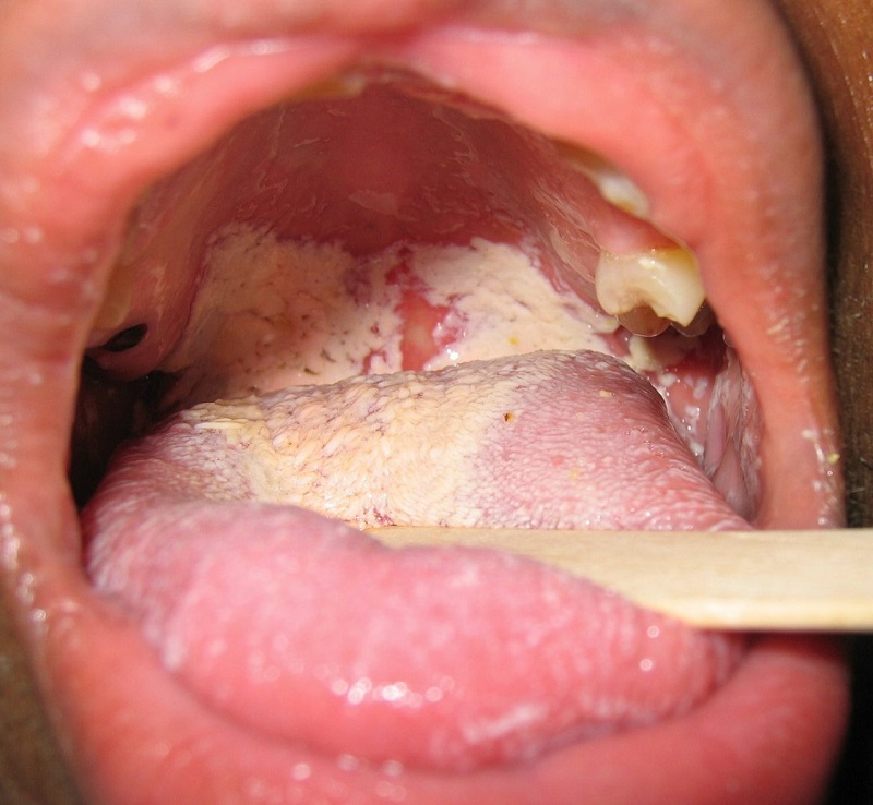 Không nên chủ quan với bệnh nấm miệng ở trẻ