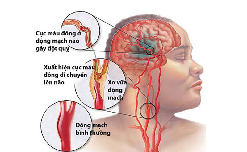Xuất huyết não xảy ra khi não bị tổn thương