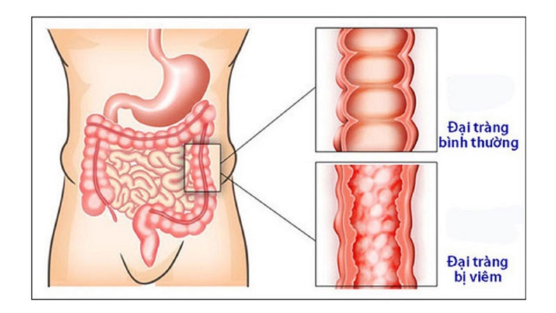Đau bụng dưới ở nam giới có thể xuất phát từ bệnh viêm đại tràng
