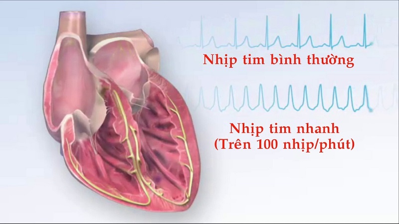 Tim đập trên 100 nhịp/phút được gọi là nhịp tim nhanh