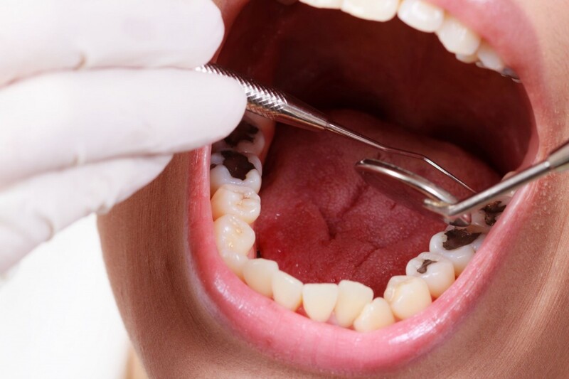 Viêm tủy răng gây đau nhức nghiêm trọng