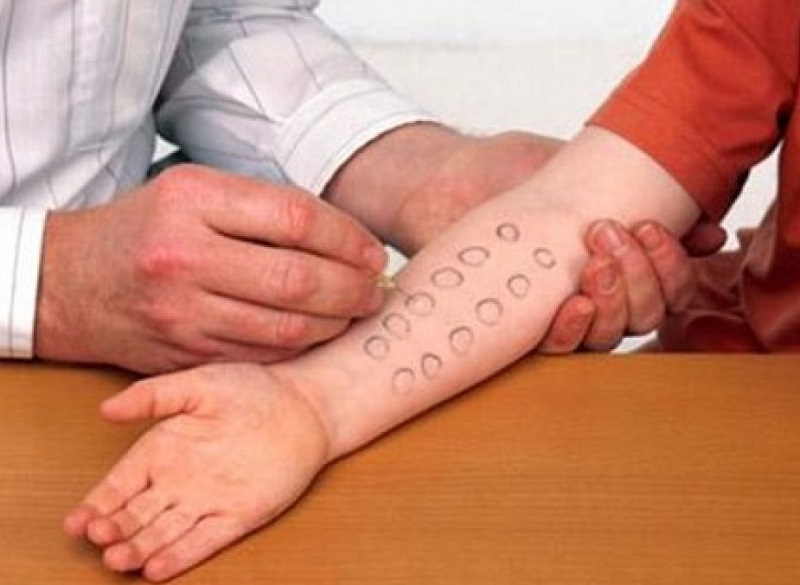 Test dị ứng - một trong những xét nghiệm thường gặp khi đi khám da liễu
