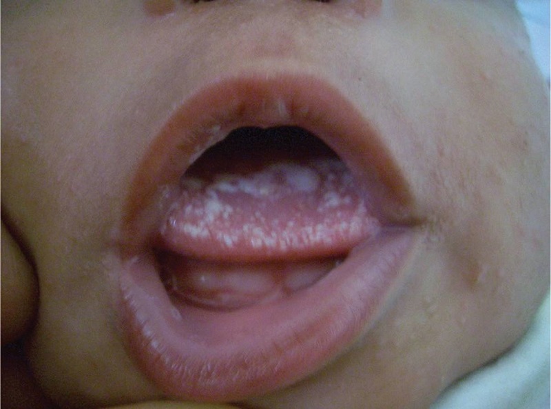 Nấm lưỡi là tình trạng thường gặp ở trẻ nhỏ