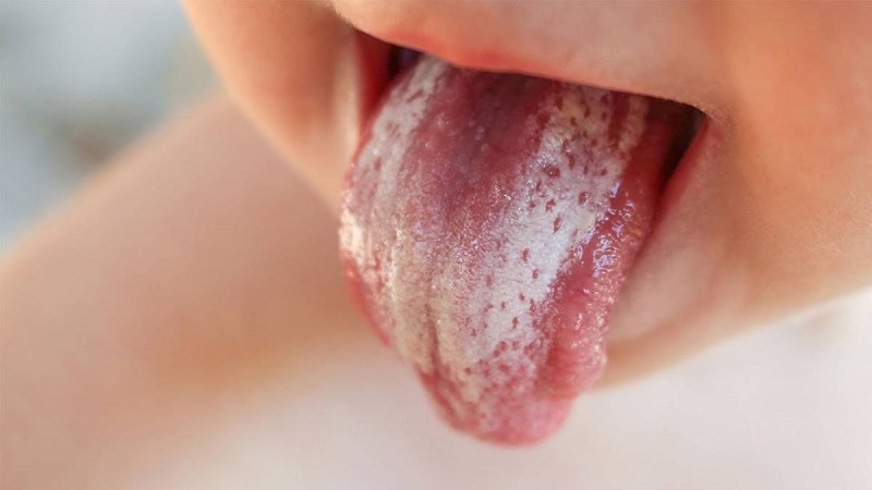 Nấm lưỡi có dấu hiệu đặc trưng là các mảng đốm trắng ở lưỡi