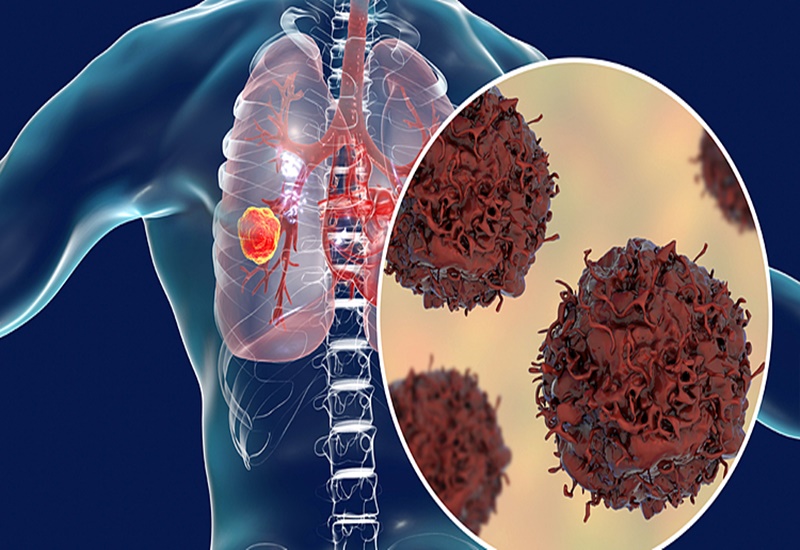 Hình ảnh mô phỏng khối u ác tính ở phổi