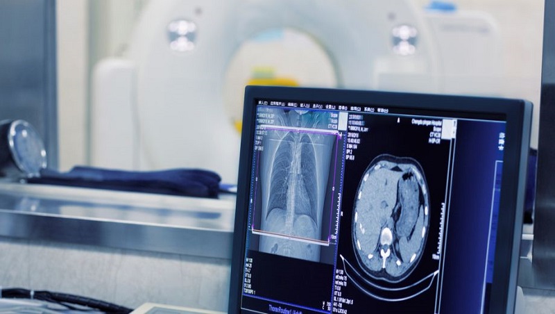 Chụp CT phổi có vai trò quan trọng trong chẩn đoán và điều trị ung thư phổi