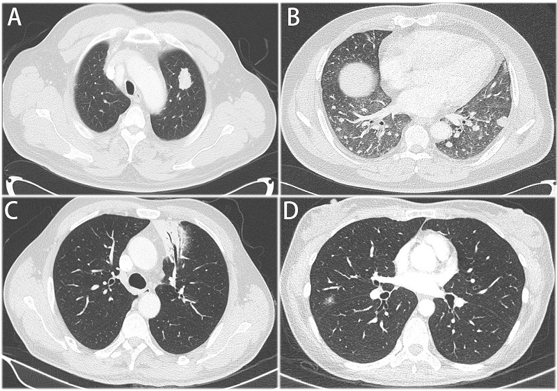  Chụp CT áp dụng cho các bệnh nhân nghi ngờ tổn thương sâu vùng phổi