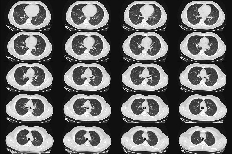 Chụp CT phổi được chỉ định trong những trường hợp nhất định