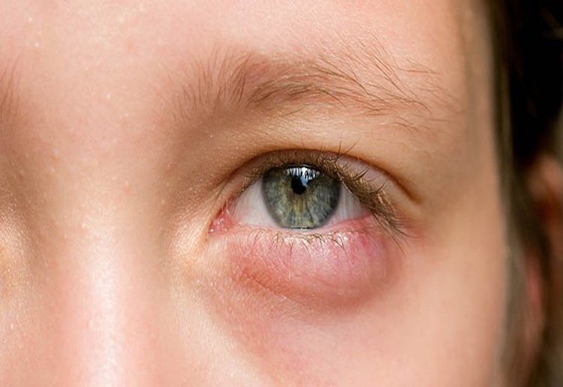 Nếu bọng mắt kèm dấu hiệu sưng đỏ, đau ngứa thì bạn cần phải hết sức cẩn thận