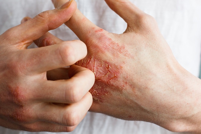 Bệnh viêm da tiếp xúc làm da tay bị đau nứt, bong tróc và ngứa ngáy