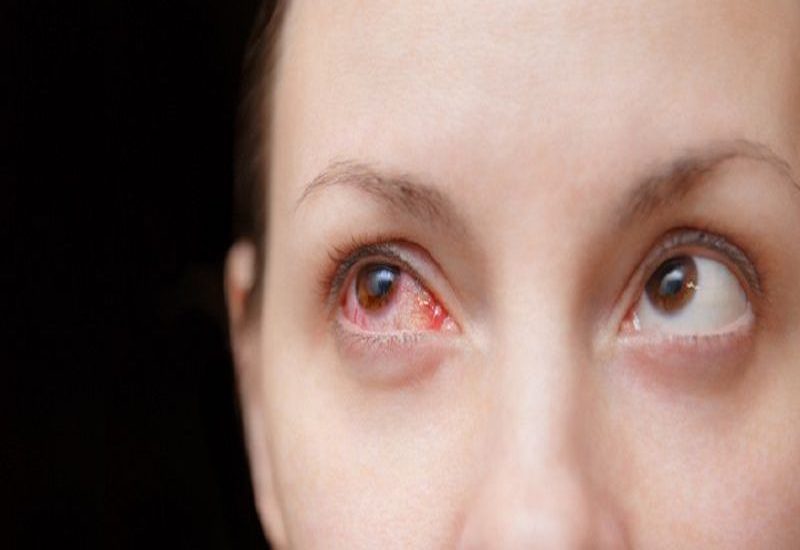 Viêm tổ chức hốc mắt  có thể khiến mắt của bệnh nhân bị đỏ, nhìn mờ, song thị,...