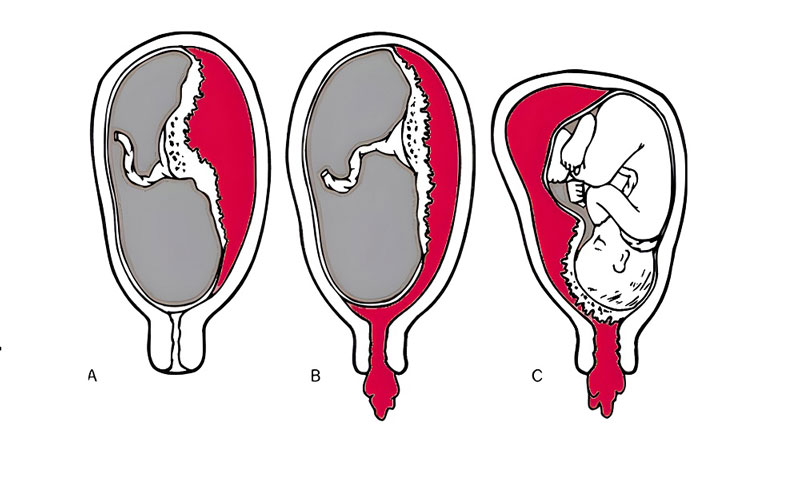 Đôi nét về tình trạng xuất huyết túi thai ở thai phụ