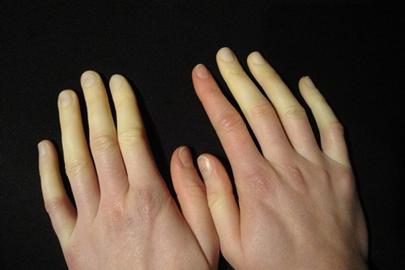 Người mắc bệnh Raynaud cũng có thể bị nhăn da tay khi tiếp xúc với nước