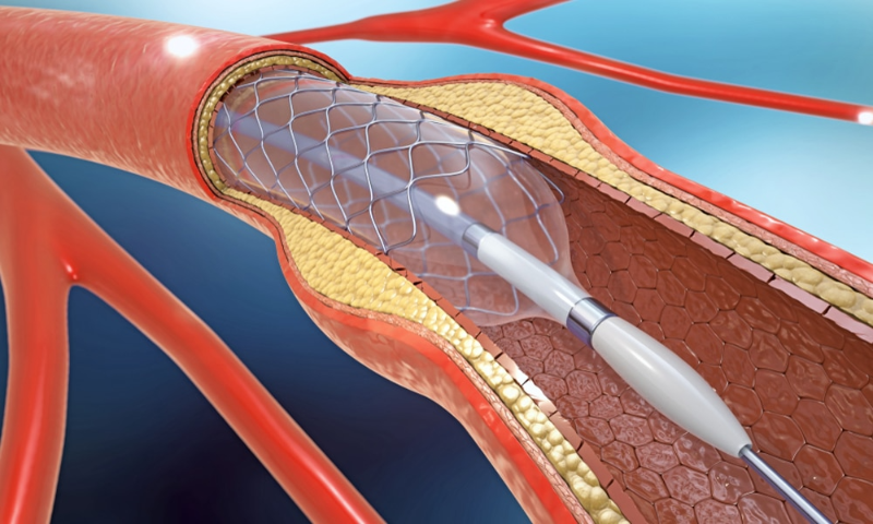 Mục đích của việc đặt stent đường mật là dẫn mật do gan sản xuất vào ruột, để thực hiện các chức năng tiêu hóa