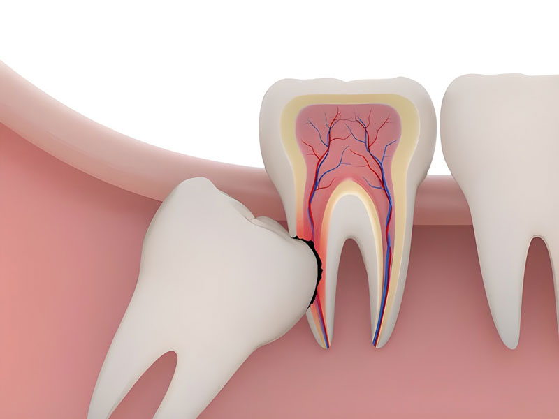 Răng khôn thường phát triển khi xương hàm của con người ngừng tăng trưởng
