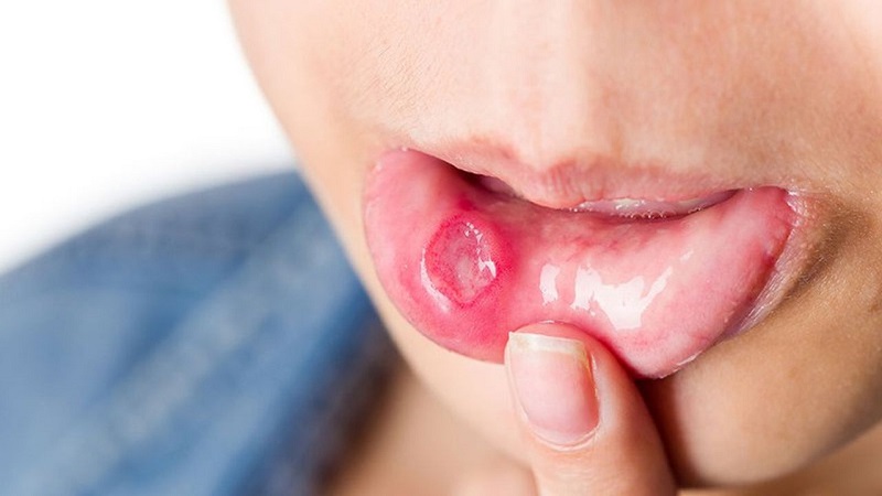 Nhiệt miệng trong cổ họng là một dạng viêm loét niêm mạc giống như vết loét ở các vị trí khác trong khoang miệng