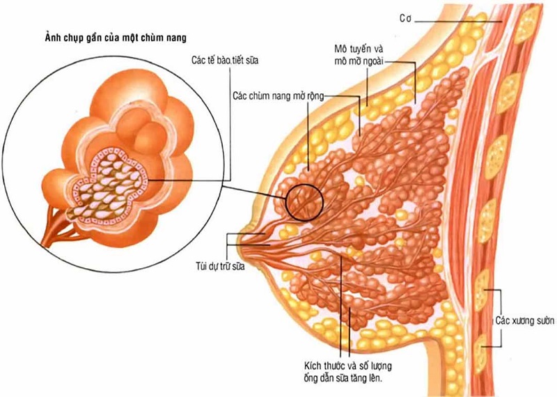 Mô phỏng về sự thay đổi về cấu trúc mô tuyến vú trong bệnh thay đổi sợi bọc tuyến vú