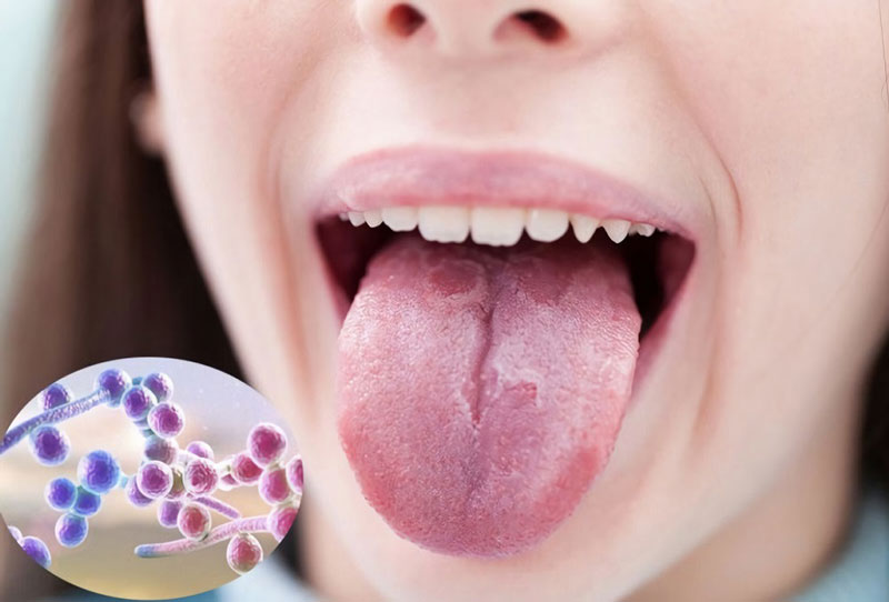Các loại thuốc dùng để điều trị bệnh nấm ở vùng miệng