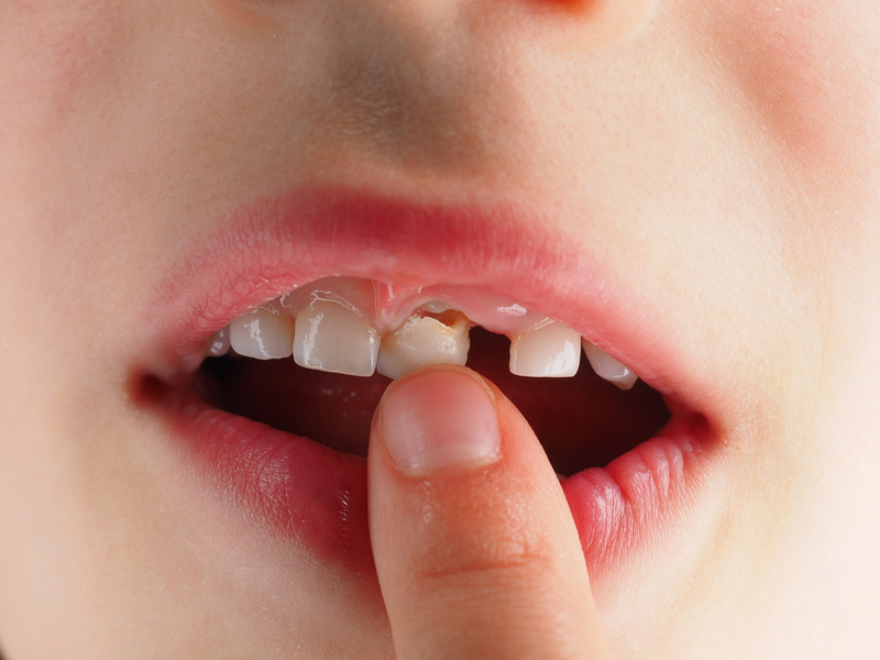 Dấu hiệu nhận biết trẻ sắp thay răng chính là răng bị lung lay kèm theo cảm giác hơi đau