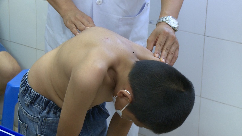 Trẻ bị gù lưng do sai tư thế có thể điều trị không cần phẫu thuật
