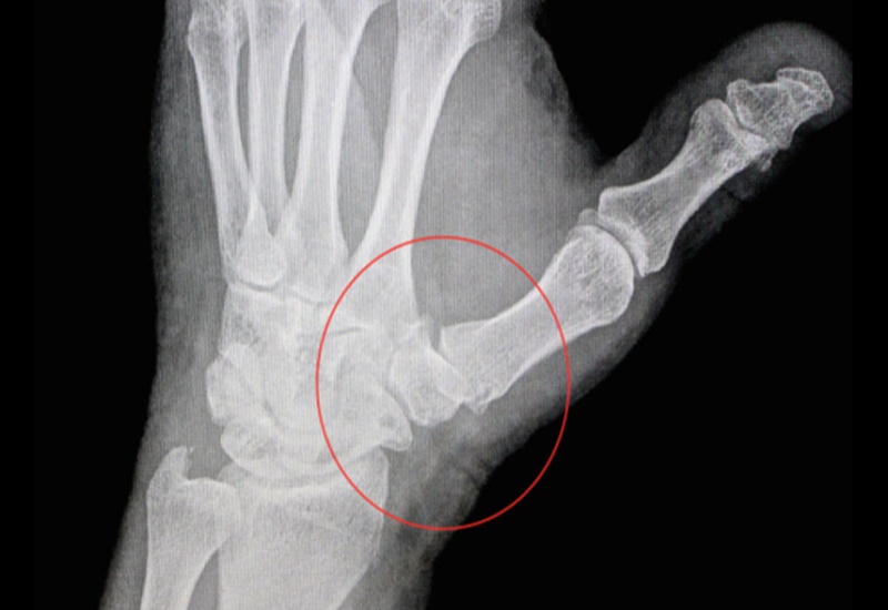 Chụp X-quang để thấy rõ tổn thương ở ngón tay cái