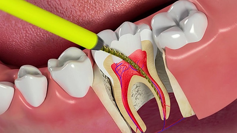 Người bị viêm tủy là một trong các trường hợp nên nhổ răng bằng máy Piezotome