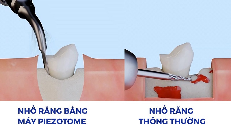 Nhổ răng bằng máy Piezotome không lo tổn thương mô mềm và xương ổ răng