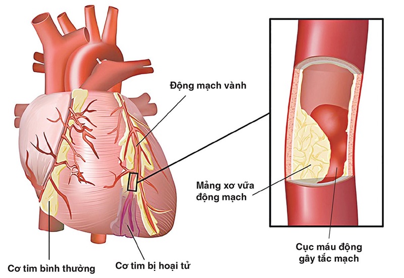 Xơ vữa động mạch có thể gây trụy tim