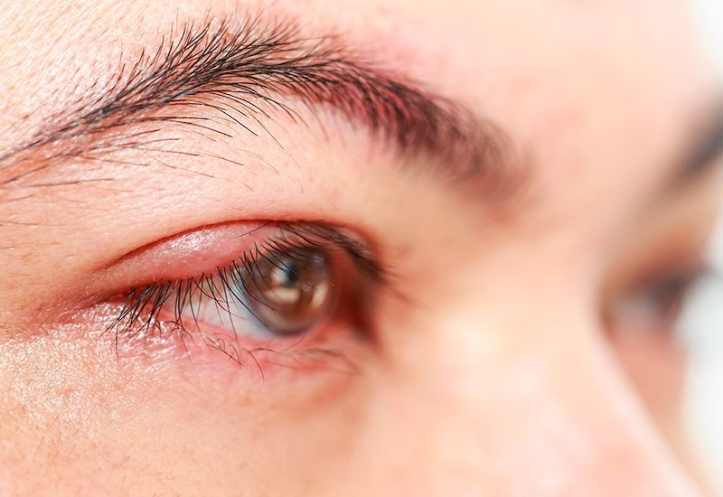 Sau chấn thương mắt nguy cơ bị xuất huyết nội nhãn là rất cao
