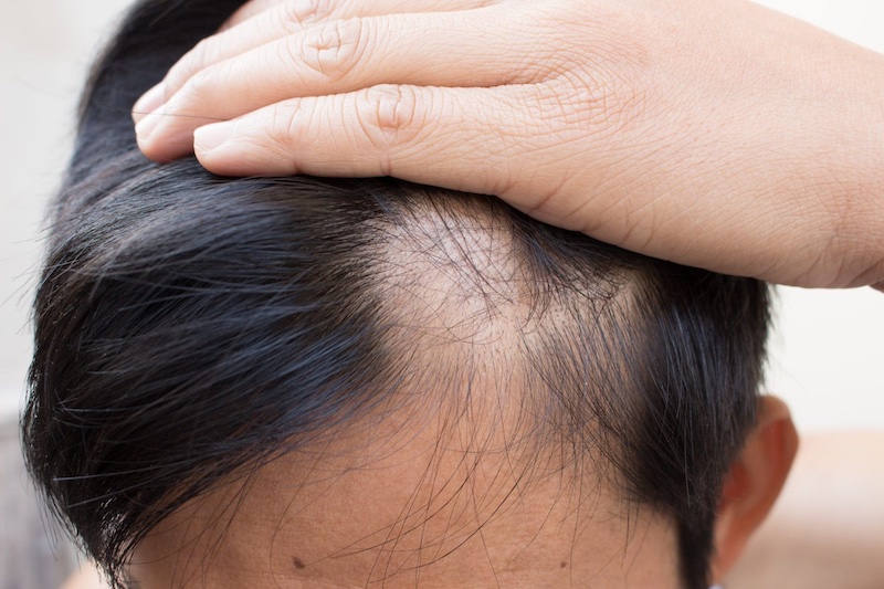 Nguyên nhân nào dẫn đến tình trạng rụng tóc thành từng mảng?