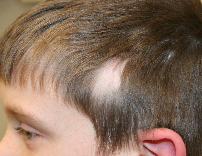 Rụng tóc từng mảng có thể xuất hiện ở bất cứ đối tượng nào