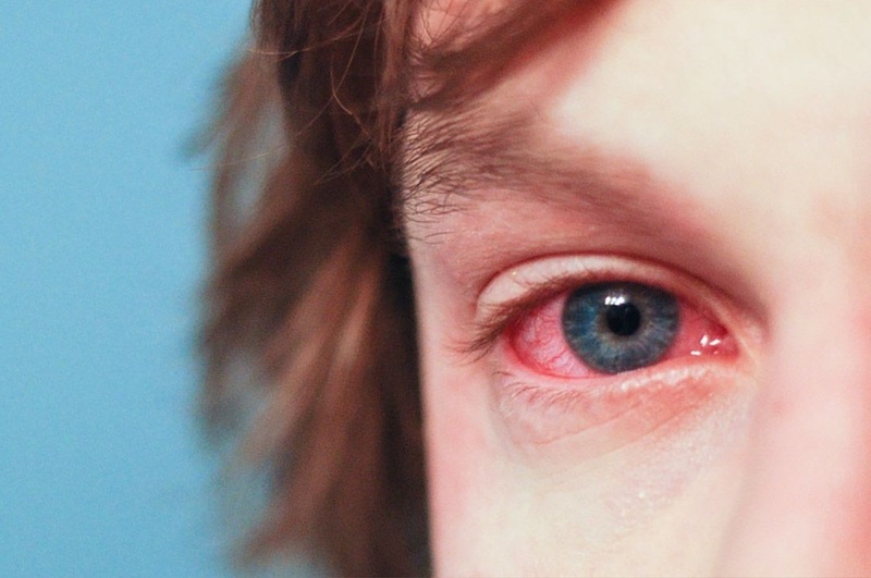 Đau mắt đỏ thường diễn biến từ 7 - 10 ngày