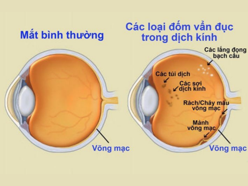 Tình trạng mắt khi bị vẩn đục dịch kính