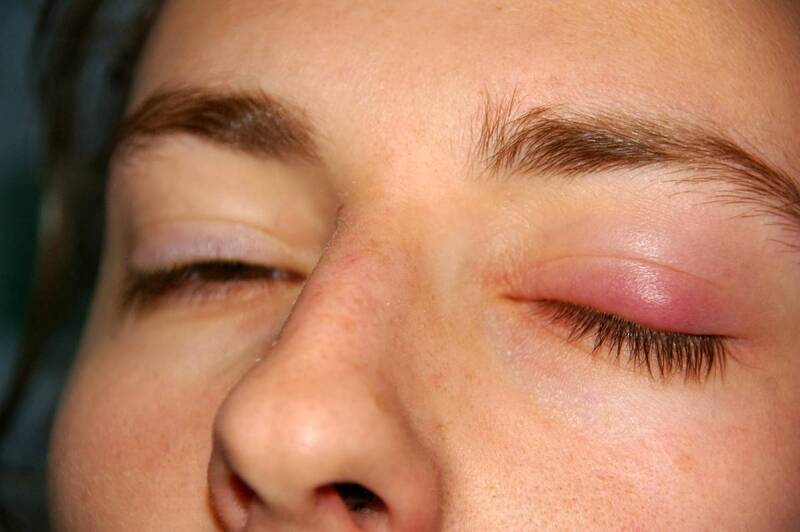 Viêm bờ mi mắt thường gây ngứa, cộm, đỏ quanh mắt