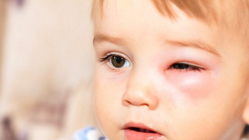Nguyên nhân gây viêm bờ mi mắt mạn tính là do tăng tiết bã nhờn