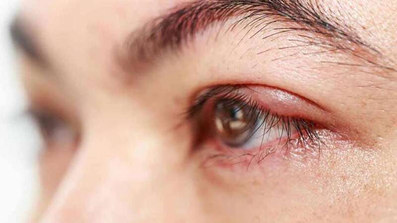 Viêm bờ mi mắt dễ ảnh hưởng đến nang lông gây mọc mụn ở mắt