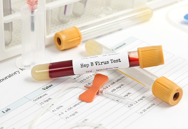 Có nhiều phương pháp xét nghiệm được ứng dụng trong chẩn đoán viêm gan B