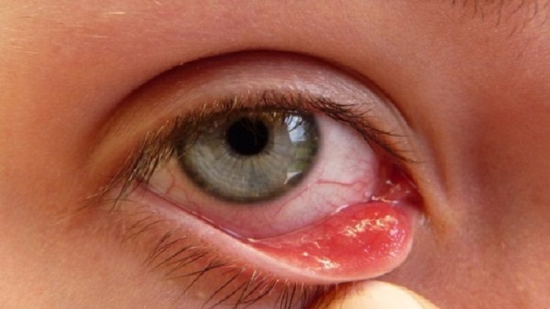 Đau mắt hột gây hình thành hạt tổn thương trên bề mặt kết mạc