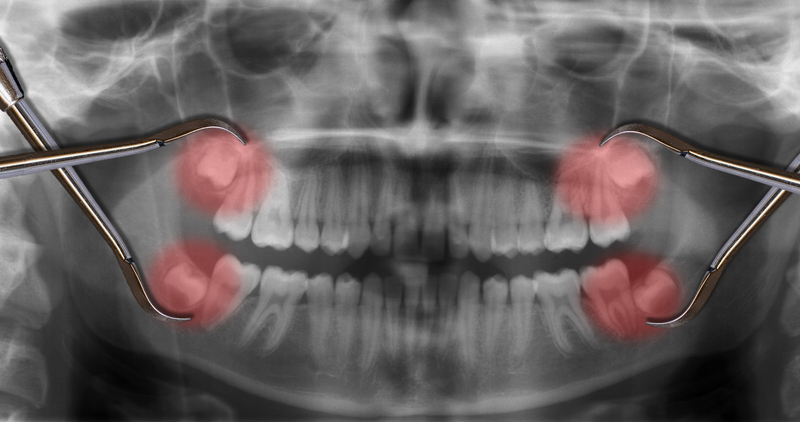 Răng mọc ngầm có thể nhìn thấy khi chụp X-quang