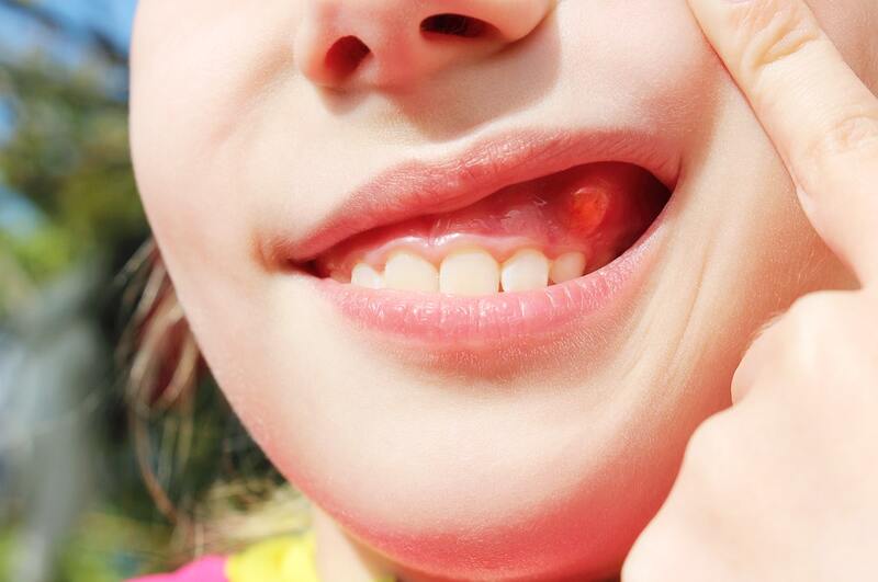 Răng mọc ngầm gây ra tình trạng đau nhức, khó chịu