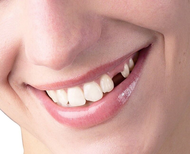 Răng mọc ngầm thường xảy ra với răng nanh hoặc răng khôn