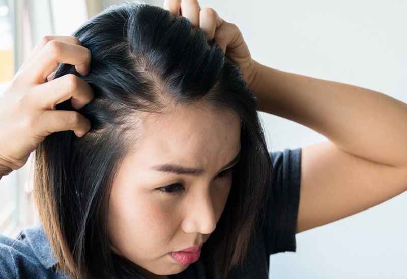 Các bệnh về da đầu gây ảnh hưởng trực tiếp đến nang tóc