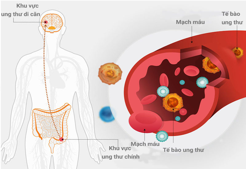 Từ vị trí ban đầu, các tế bào ung thư sẽ di căn thông qua đường máu và hệ bạch huyết để tìm đến các cơ quan khác