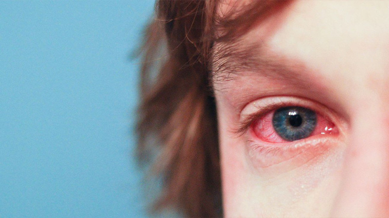 Tổn thương giác mạc ảnh hưởng đến thị lực người bệnh