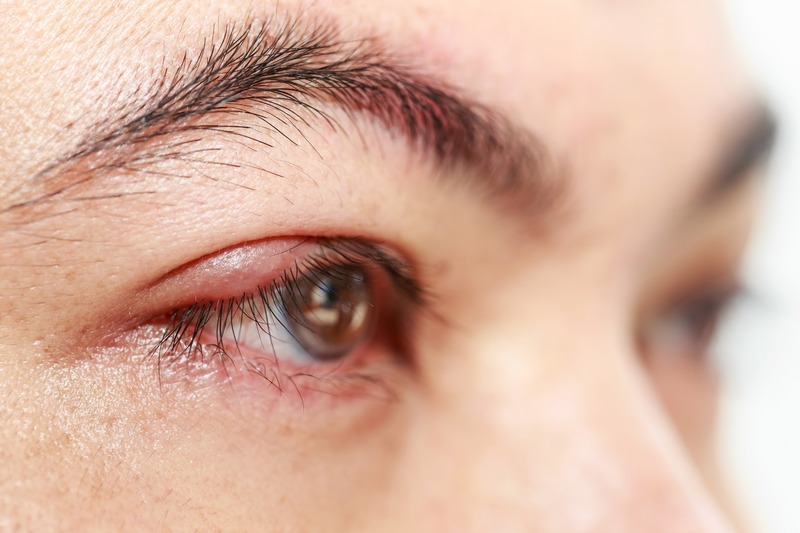 Viêm mống mắt có thể là nguyên nhân khiến mắt nhòe mờ