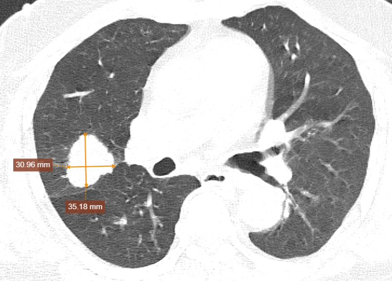 Hình ảnh khối u phổi được phát hiện nhờ phương pháp chụp CT tại MEDLATEC 