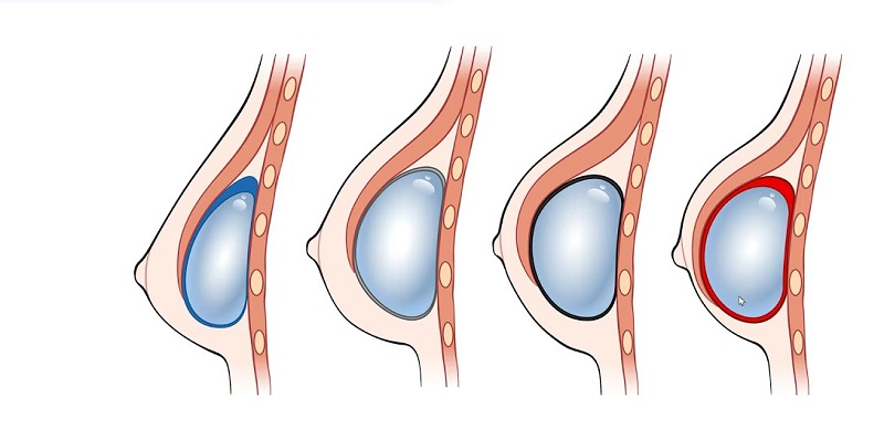 Phẫu thuật nâng ngực không an toàn có thể gây biến chứng co thắt bao xơ 