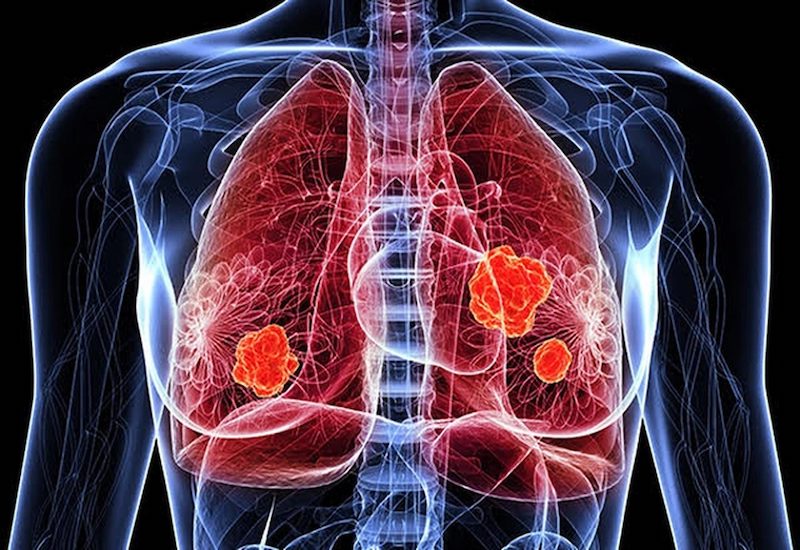 Tế bào ung thư phổi giai đoạn 3 sẽ tấn công mạnh mẽ ở nhiều vị trí tại phổi