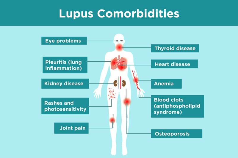 Tùy mức độ tổn thương của  Lupus ban đỏ mà biểu hiện sẽ có sự khác nhau