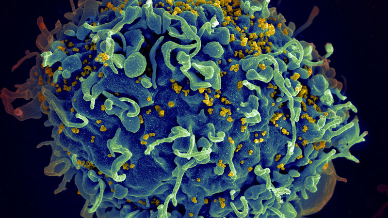 Virus HIV là nguyên nhân gây suy giảm hệ miễn dịch của con người